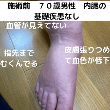 70歳男性浮腫