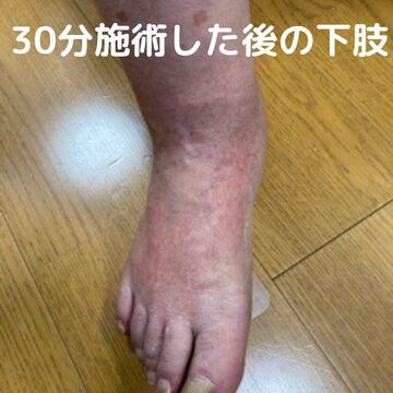 70歳男性足の浮腫